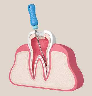 Re-Root Canal Treatment